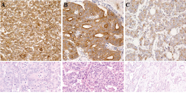 Trk protein expression by IHC in A. patient #1 B. patient #2 and C. patient #3.