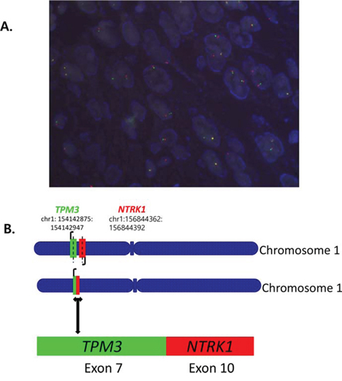 A. Fluorescence in situ hybridization (FISH) for break-apart of NTRK1 gene and B. TPM3-NTRK1 fusion with the 5&#x2019;end of NTRK1, including the kinase domain, starting at exon 10 fused to exon 7 of TPM3 by NGS.