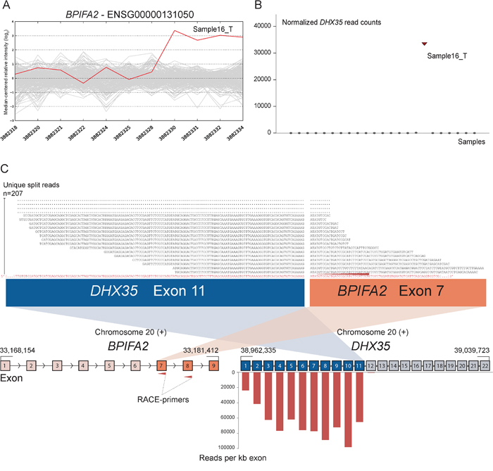 Novel fusion between DHX35 and BPIFA2 is in concordance with 3&prime; overexpression of BPIFA2.