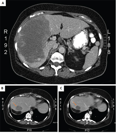 CT scans of primary tumor at diagnosis A.