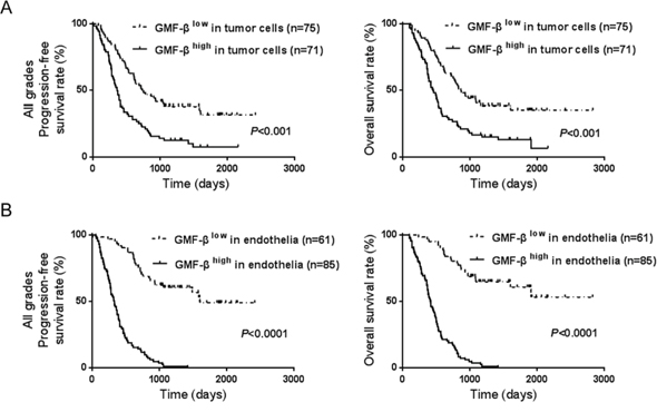 GMF-&#x03B2; expression is negatively correlated with prognoses of glioma patients.