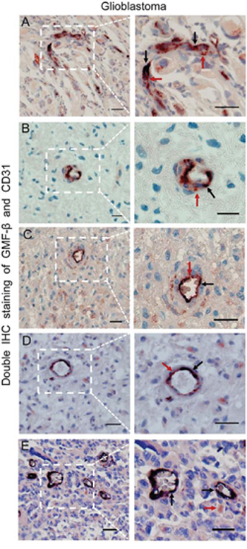 GMF-&#x03B2; is involved in neovasculogenesis in human glioblastoma.