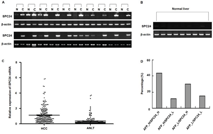 SPC24 mRNA expression in HCC specimens analyzed by RT-PCR and real-time RT-PCR.
