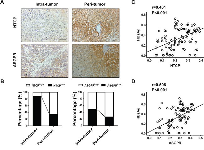 HBsAg expression significantly correlates with NTCP and ASGPR expression in peritumoral tissues of HBsAg-positive HCC patients.