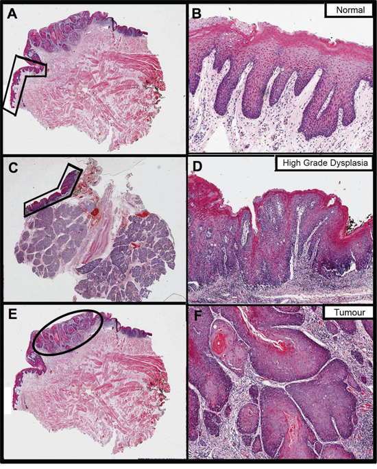 Figure 1: The fixed sections that were H&E stained and annotated to guide RNA extraction from a single patient (ID PG063) in this study.