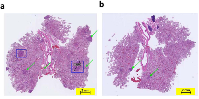 Knocking out the COX-2 gene in K-ras mice inhibited the formation of adenocarcinoma in the lungs by age 4 months.