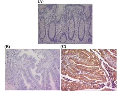 PK-R2 protein expression in healthy human colorectal mucosa and human primary colorectal cancer by immunohistochemical staining with anti-PK-R2 mAb
