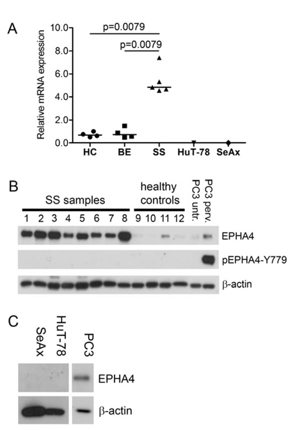 EPHA4 and phosphorylated EPHA4 expression in SS.