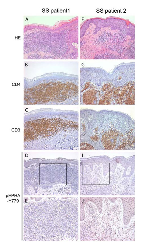 Phosphorylated EPHA4 expression in skin biopsies of SS patients.