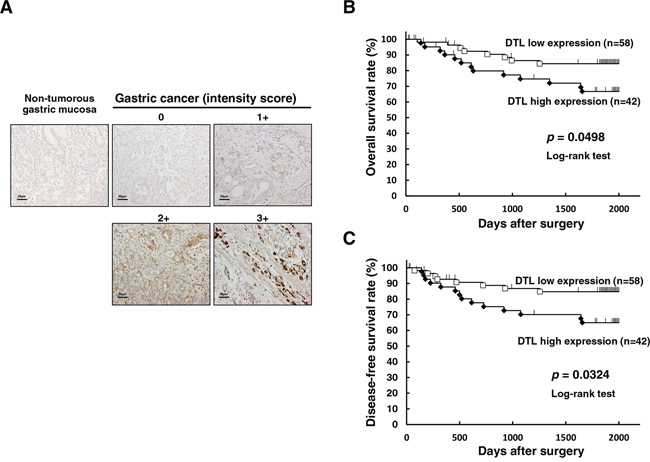 Immunohistochemical-staining analyses and postoperative overall survival curve according to the expression of DTL.