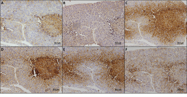 Immunohistochemical staining patterns of metabolism-related proteins in a case representative of the glycolytic phenotype.
