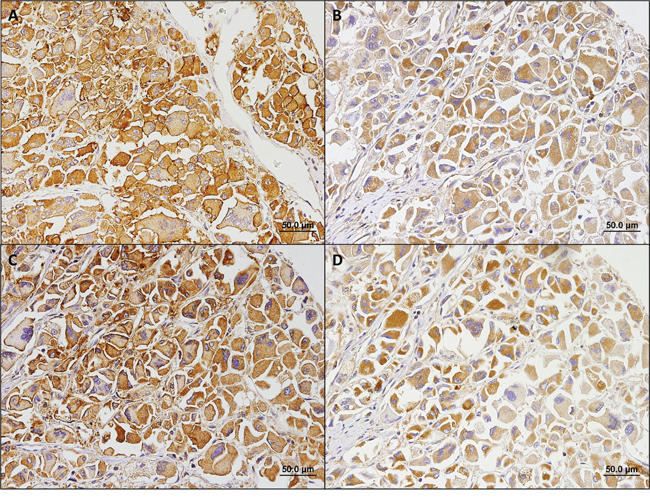 Immunohistochemical staining patterns of metabolism-related proteins in a case representative of the oxidative phenotype.