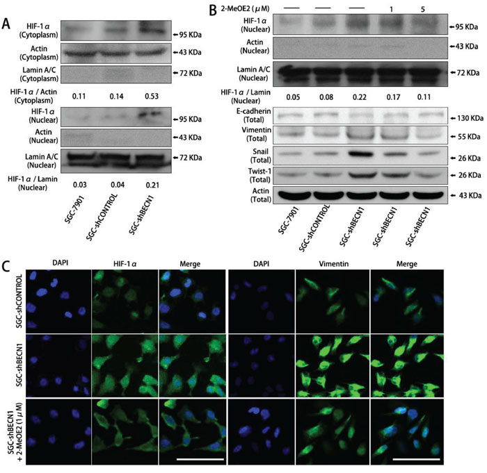 The EMT induced by autophagy inhibition is dependent on HIF-1&#x03B1; activation in gastric cancer cells.