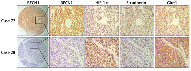 Immunohistochemical analysis of consecutive sections from human gastric cancer tissues.
