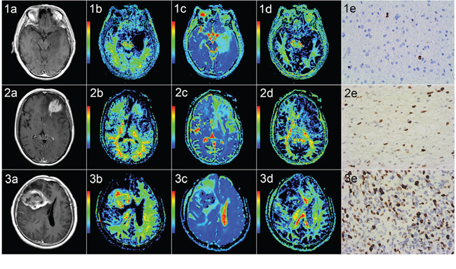 Correlation of diffusion kurtosis imaging with tumor grade and Ki-67.