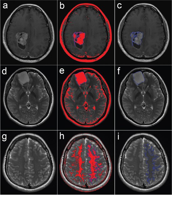 Semi-automated delineation of the ROIs over the solid region of the tumor and the NAWM.