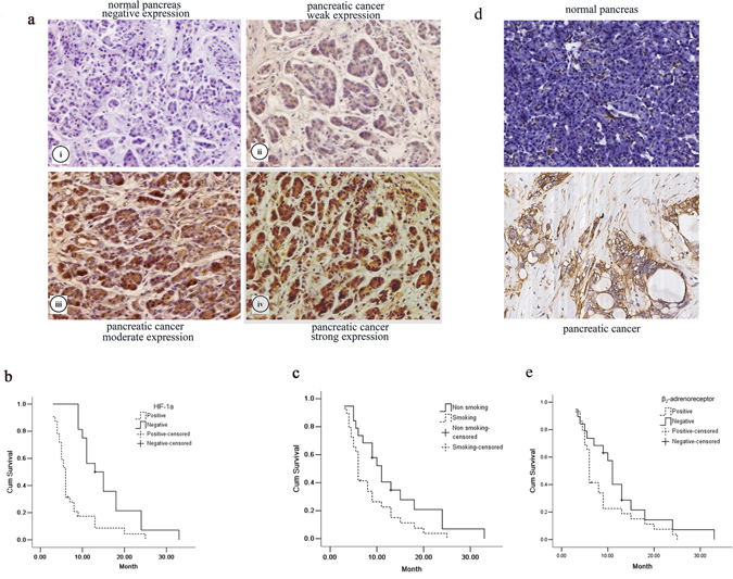 The effect of HIF-1&#x03B1; and &#x03B2;2-AR expression and smoking on pancreatic cancers.