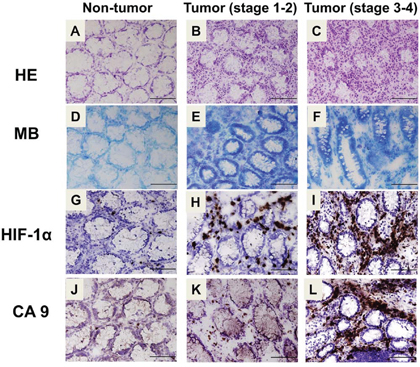 Histological and immunohistochemical analysis for hypoxia and CA9 expression in human colon cancer.