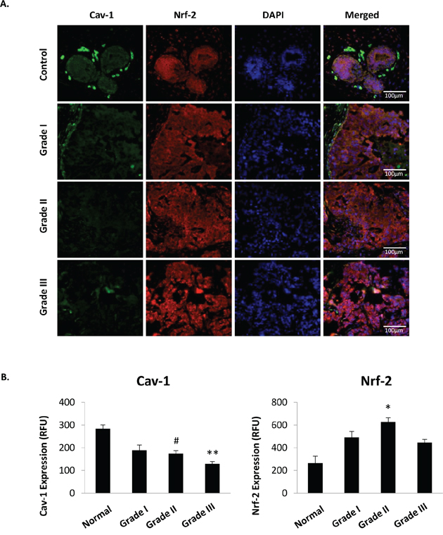 Cav-1 and Nrf2 protein expression are inversely associated in human breast cancer tissue.