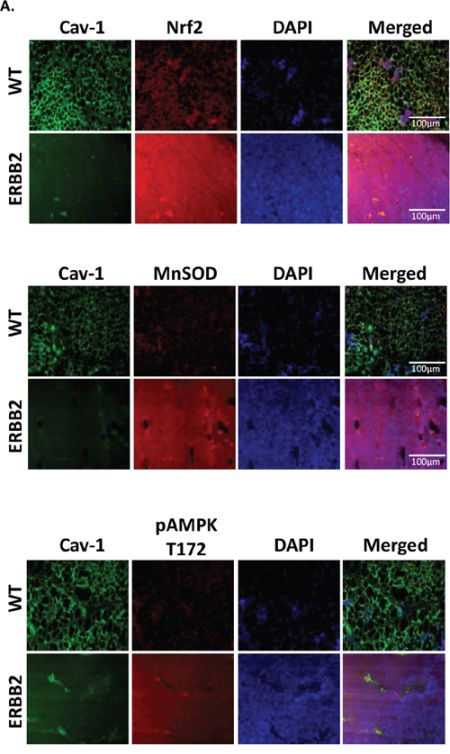 Cav-1 is repressed and MnSOD is increased in an in vivo model of malignancy.