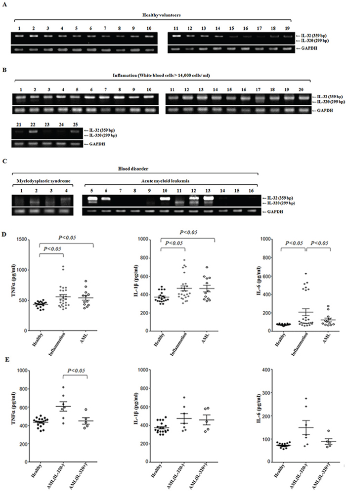 Inhibitory effects of IL-32&#x03B8; on the production TNF-&#x03B1; in AML.