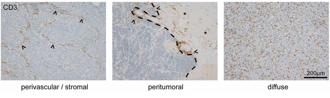 T-Lymphocyte infiltration patterns in human brain metastases.