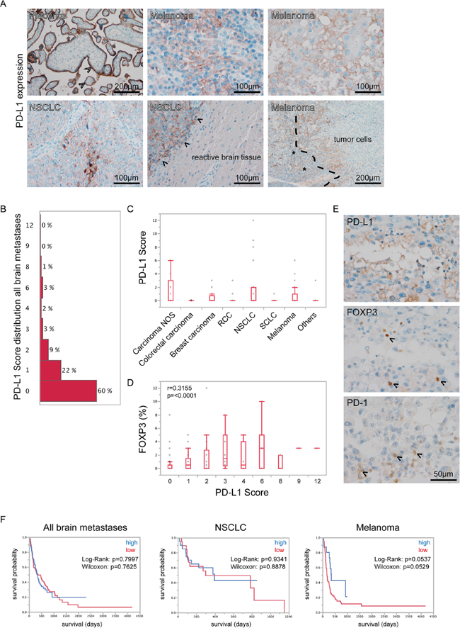 PD-L1 expression in human brain metastases.