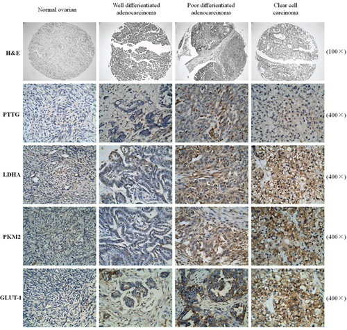 Analysis of the expression level of PTTG, as well as that of aerobic glycolysis-related enzymes PKM2, LDHA, and GLUT-1 in various differentiated ovarian carcinoma tissues.