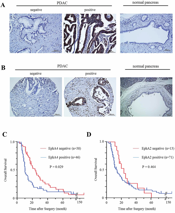 Expression of EphA4 and EphA2 in human PDAC tissues and its correlation with overall survival.