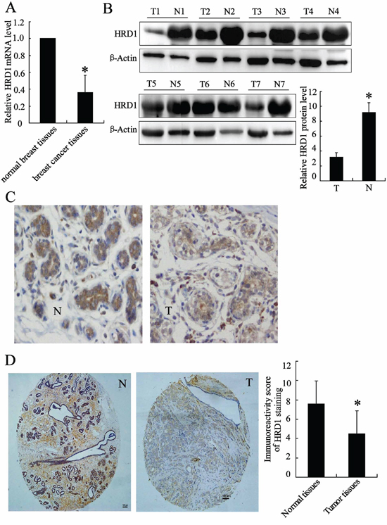 HRD1 was downregulated in breast cancer versus non-cancer tissues.