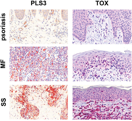 Immunohistochemical staining for PLS3 and TOX.