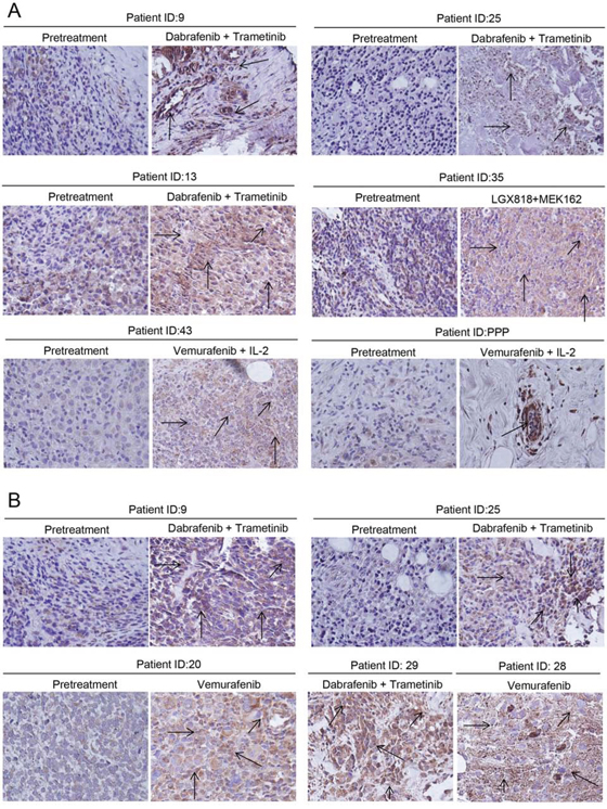 Tumor biopsy samples exhibited enhanced Mcl-1 expression in patients treated with BRAF inhibitor alone or in combination with MEK1/2 inhibitor.