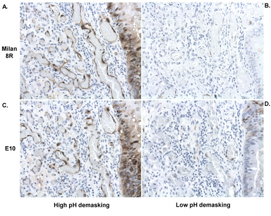 Adjacent sections of pretreatment biopsies demonstrating effects of high