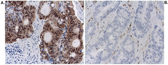 Staining for pERK (Milan8R antibody) in cancer and stromal cell nuclei.