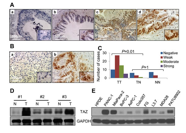 Expression of TAZ in pancreatic tumors and pancreatic cancer cell lines.