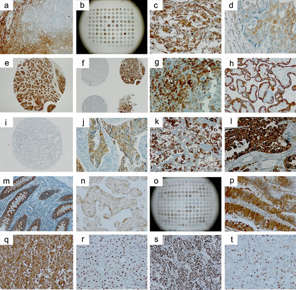 Selected immunohistochemical images from the stainings of the tissue arrays.