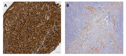 Immunohistochemistry of cyclin D1.