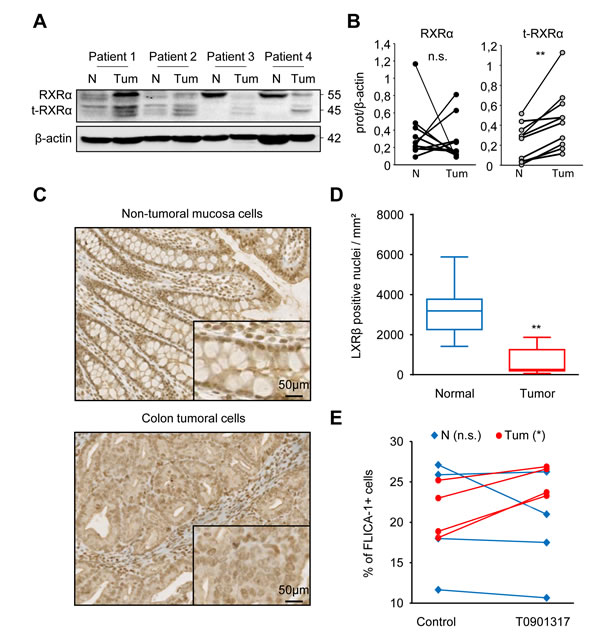 Normal colon mucosa cells from colon cancer patients are not sensitive to treatment with an LXR agonist.