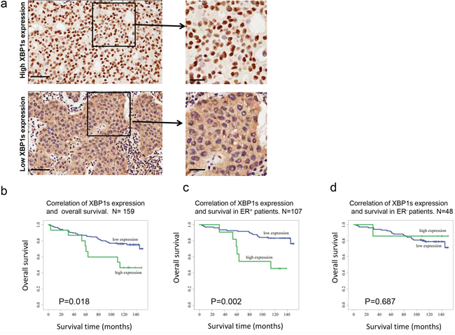 XBP1s expression is highly correlated with overall survival of ER+ breast cancer patients.