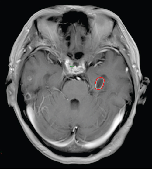 Magnetic resonance image of a patient who has a hippocampal metastasis.