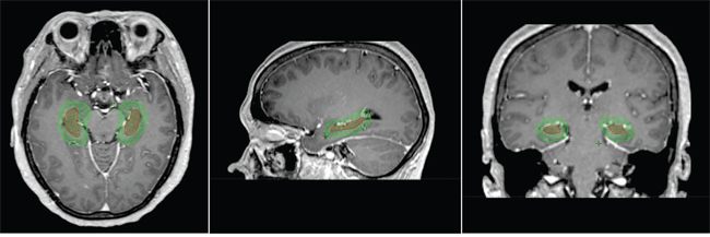 Hippocampus contoured on axial, sagittal, and coronal contrast-enhanced T1 magnetic resonance images.