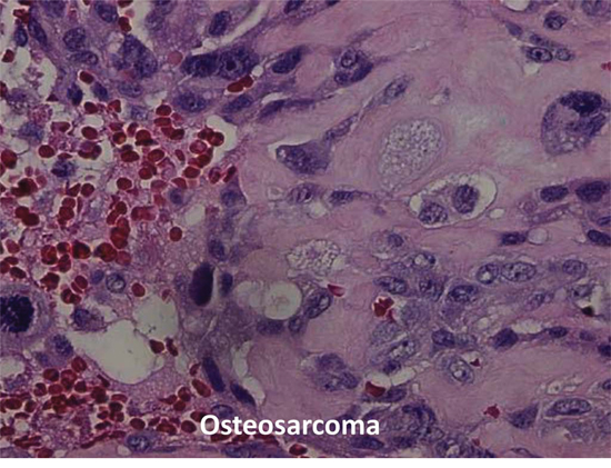 Histopathology figure of osteosarcoma from patient # 1.