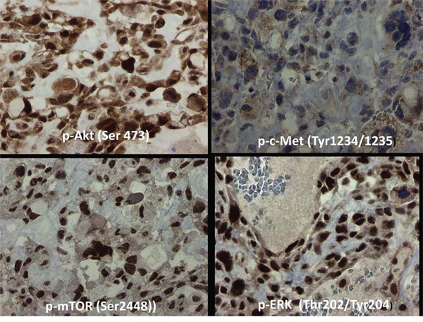 Immunohistochemistry based morphoproteomic studies of osteosarcoma Patient #1.