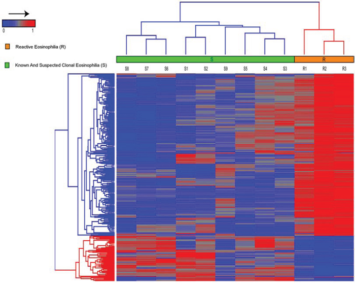 Hierarchical clustering, using Euclidean distance and complete linkage of 285 probes, show differential methylation between patients with known and suspected clonal eosinophilia (S1&ndash;S9) versus patients with reactive eosinophilia (R1&ndash;R3).