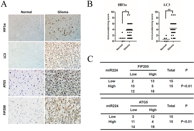 miR224-3p inversely correlates with ATG5 and FIP200 expression in human glioma tissues.