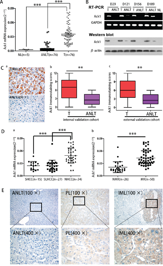 Ack1 expression is significantly increased in HCC and correlated with HCC metastasis.