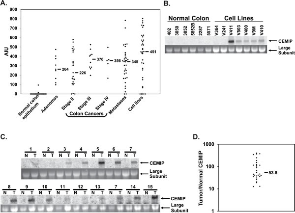CEMIP mRNA expression in normal colon epithelium and colon cancer samples.