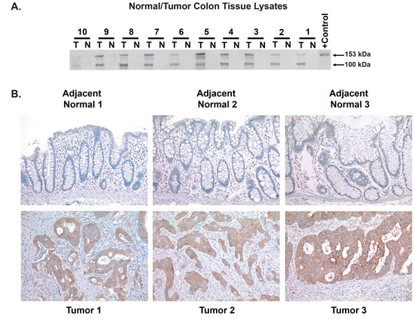 Induction of CEMIP protein in patient colon tumor samples.