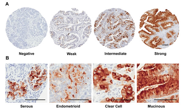 Tissue microarray staining for SPINK1.