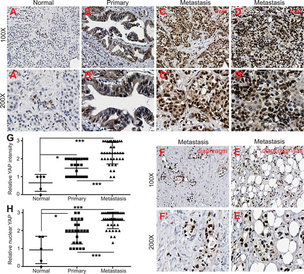 Upregulation and nuclear localization of YAP in metastatic pancreatic tumors.
